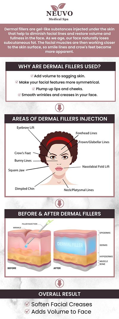 Fillers at Neuvo Medical Spa are a popular non-surgical solution to restore volume, smooth wrinkles, and enhance facial contours. Our team of skilled specialists uses advanced techniques to ensure natural-looking results tailored to your unique needs. Whether you're looking to plump lips, lift cheeks, or reduce fine lines, we provide personalized treatments that help you achieve a refreshed, youthful appearance. For more information, contact us or request an appointment online. We are conveniently located at 2653 Bruce B Downs Blvd, Unit 119, Wesley Chapel, FL 33543