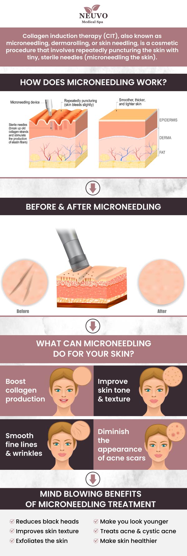 At Neuvo Medical Spa, our Microneedling treatment uses tiny needles to stimulate collagen production, improving skin texture, reducing scars, and minimizing fine lines. Our team tailors each treatment to your skin's needs, ensuring a safe and effective experience. Trust our professionals to help you achieve smooth, rejuvenated skin with minimal downtime. For more information, contact us or request an appointment online. We are conveniently located at 2653 Bruce B Downs Blvd, Unit 119, Wesley Chapel, FL 33543.

